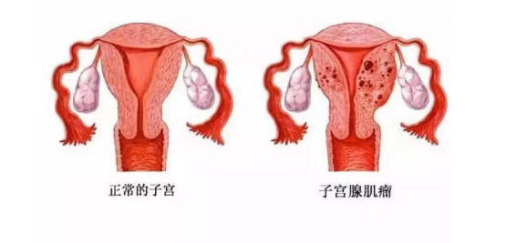 子宫肌瘤多大需要手术